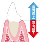 d_24 歯肉縁上縁下
